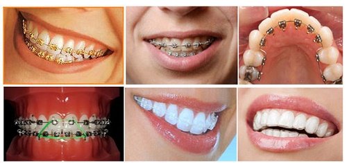 Các loại niềng răng mắc cài 1