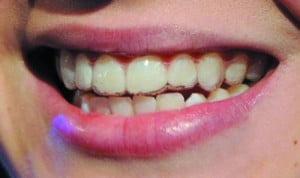 Điều chỉnh hàm răng với phương pháp niềng răng