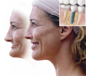 lợi ích của trồng răng implant