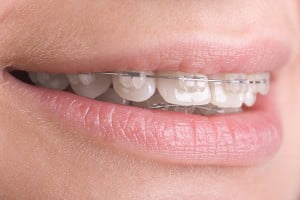 Những phương pháp điều trị răng cửa