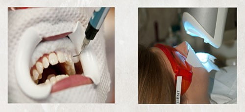 Những phương pháp tẩy trắng răng tại nha khoa