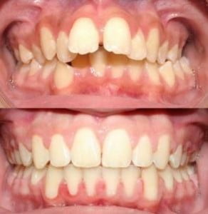 So sánh cắt hàm hô và niềng răng chỉnh nha