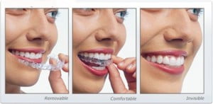 Tìm hiểu phương pháp niềng răng