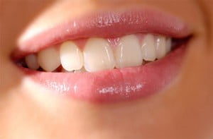Cách khắc phục răng khểnh