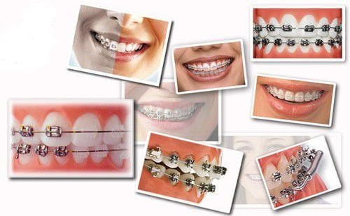 Phương pháp niềng răng không nhổ răng 1