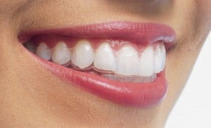 Phương pháp niềng răng không nhổ răng