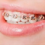 Giải pháp niềng răng rẻ nhất hiện nay
