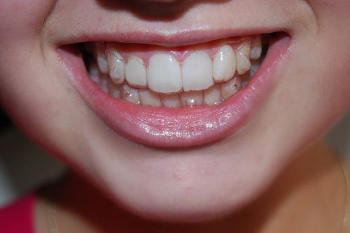 Những tác dụng của phương pháp niềng răng
