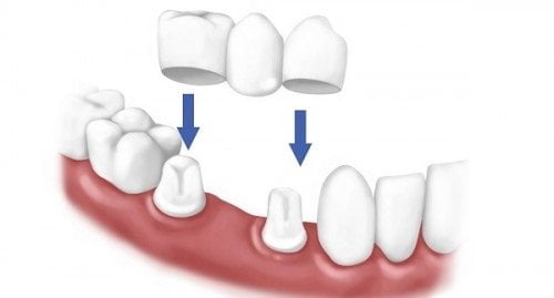 Trồng răng cửa có đau không? Tìm hiểu các kỹ thuật trồng