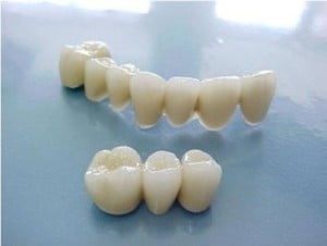 Bọc răng sứ thẩm mỹ đơn giản và hiệu quả