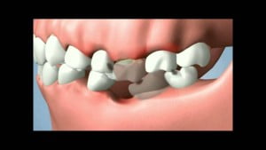 Hậu quả đau hàm, chết tủy do chỉnh răng không đúng cách