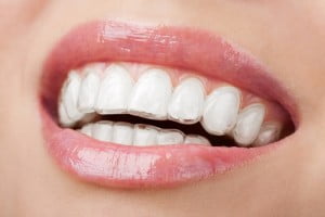 Những mặt có lợi của niềng răng invisalign
