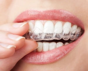 Niềng răng không mắc cài Invisalign có đau không ?