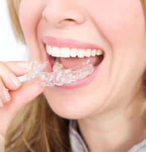 Niềng răng không mắc cài hiệu quả