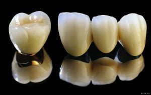 Răng sứ titan là gì ?
