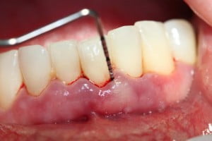 Tẩy trắng răng không nên thực hiện cho đối tượng nào ?