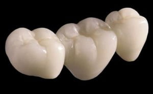 Thẩm mỹ hàm răng bằng cách bọc răng sứ cao cấp