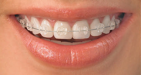 Những phương pháp niềng răng thẩm mỹ