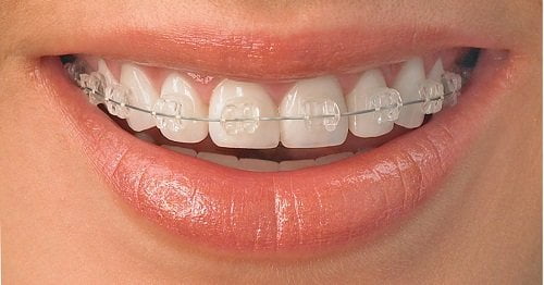 Niềng răng thẩm mỹ có tốt không? Tìm hiểu tại nha khoa 2