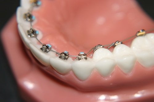 Niềng răng thẩm mỹ có tốt không? Tìm hiểu tại nha khoa 3
