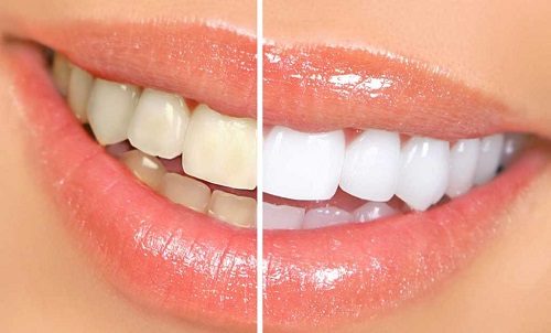 Tẩy trắng răng có tốt không? Nghe tư vấn từ nha sĩ 1