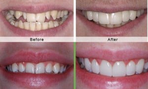 Cách giải quyết nhanh khi răng bị nhiễm màu
