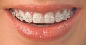 Niềng răng hô hàm trên mất bao lâu ?