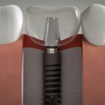 Trồng răng implant có ảnh hưởng đến sức khỏe không?