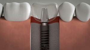 trồng răng implant có ảnh hưởng sức khỏe không