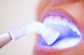 Nên tẩy trắng răng tại nha khoa hay tại nhà