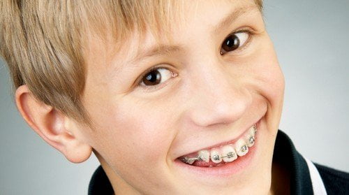Niềng răng lứa tuổi nào hợp lý? 1