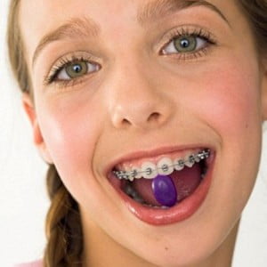 Phương pháp niềng răng cho trẻ em như thế nào ?