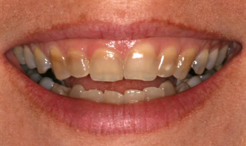 Tẩy trắng răng bị nhiễm tetracycline hiệu quả tại nha khoa