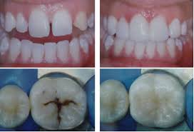 Thẩm mỹ hàm răng tại nha khoa