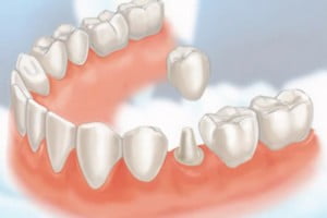 Cách chăm sóc hàm răng sau khi bọc răng sứ