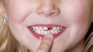 Niềng răng lứa tuổi nào là hợp lý ?