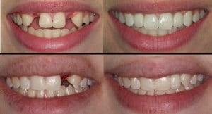 Răng giả cố định bằng sứ titan có tốt không? 
