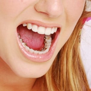 Có những loại niềng răng nào ?