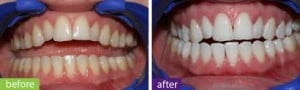 Giúp bạn hiểu hơn về tẩy trắng răng