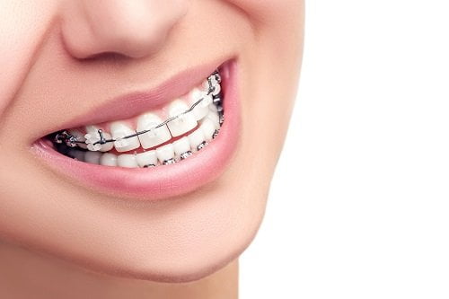 Tìm hiểu thông tin về niềng răng mắc cài 3m ugsl 1