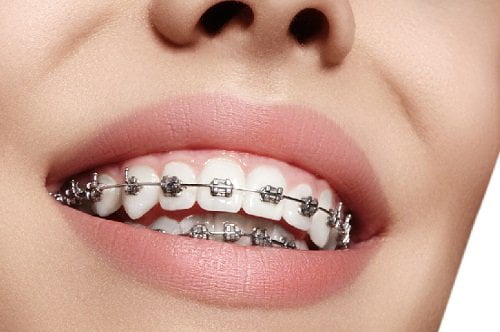 Niềng răng mắc cài kim loại giá bao nhiêu? Thông tin nha khoa 1