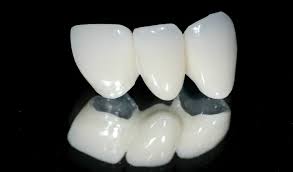 So sánh răng sứ kim loại và không kim loại