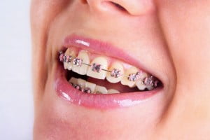 Răng thưa nên chỉnh răng như thế nào ?