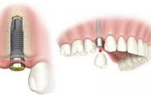 Sử dụng răng sứ thay thế răng vĩnh viễn bị mất 