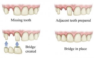 Sử dụng răng sứ thay thế răng vĩnh viễn bị mất 