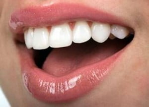 Bọc răng sứ áp dụng cho những trường hợp nào