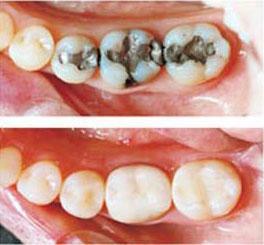 Bọc răng sứ áp dụng cho những trường hợp nào