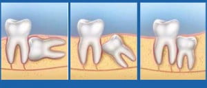 Tai biến khi mọc răng khôn và cách điều trị
