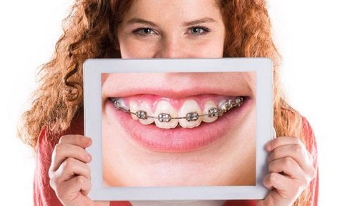 Các loại mắc cài trong chỉnh nha 2