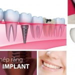 Cấy ghép răng implant có đau không ?